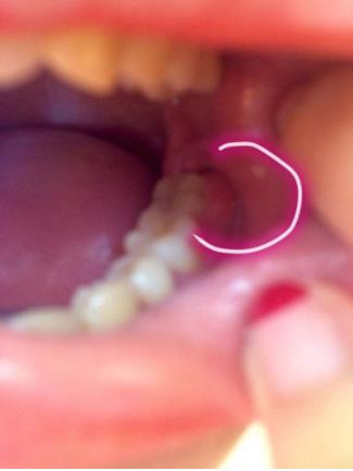 智齿牙龈肿痛怎么办:长智齿引起牙龈肿痛 智齿牙龈肿痛怎么办:长智齿引起牙龈肿痛