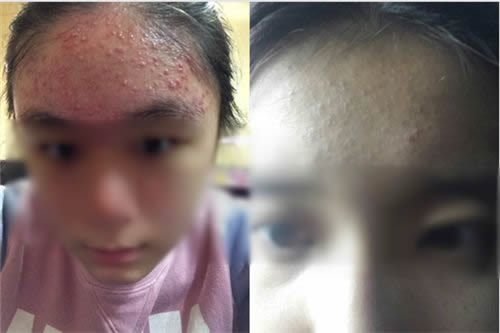 粉刺图片闭口粉刺是什么:闭口粉刺形成原因及怎么去除 粉刺图片闭口粉刺是什么:闭口粉刺形成原因及怎么去除