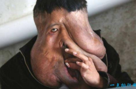 三,中国最丑男人,面部巨瘤重达15公斤