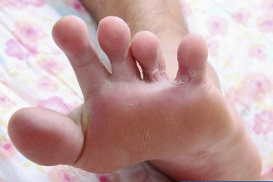 香港脚可分为水疱型,糜烂型,鳞屑角化型脚气,治疗最好的方法在于预防