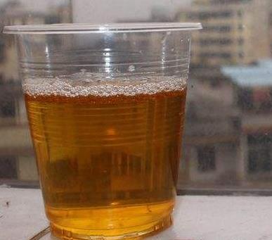 小便黄是什么原因：有危害吗,尿黄相关知识