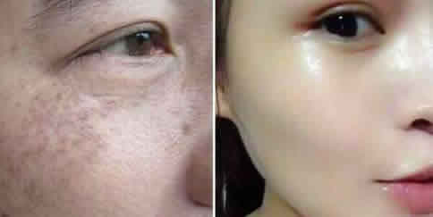 大蒜祛斑的方法:大蒜祛斑方法步骤不妨试试吧