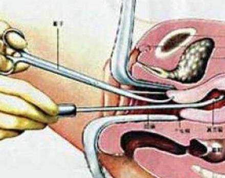 流产后多久来月经：大约1个月月经来潮