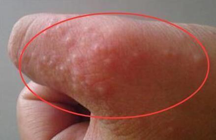 手指上起小水泡：汗疱疹千万不挠它（图）