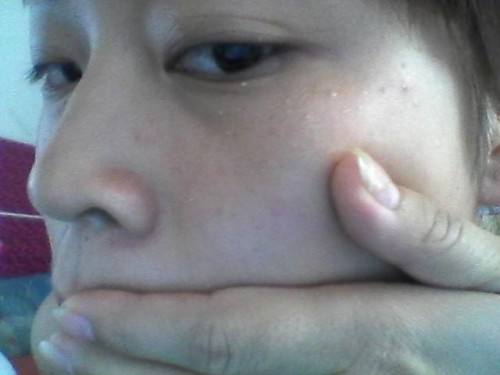 脂肪粒是怎么形成的：一种长在皮肤上的白色小疙瘩