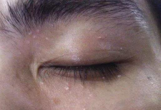 脂肪粒是怎么形成的：一种长在皮肤上的白色小疙瘩