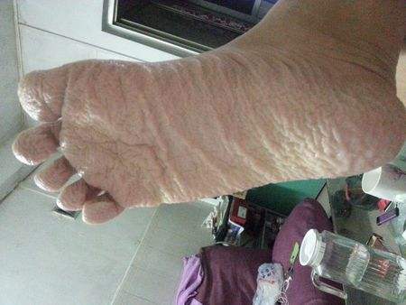 脚脱皮怎么办：教你改善脱皮小技巧