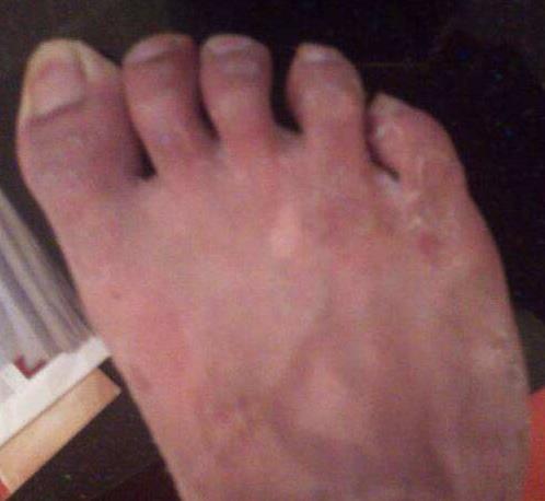 脚脱皮怎么办:教你改善脱皮小技巧 脚脱皮怎么办:教你改善脱皮小技巧