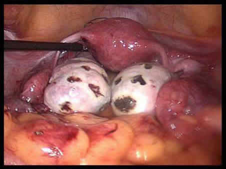 多囊卵巢综合症能治好吗:病因因素及怎么治疗 多囊卵巢综合症能治好吗:病因因素及怎么治疗