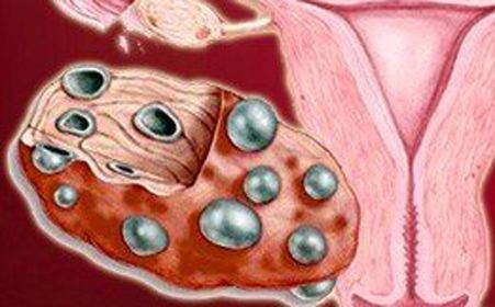 多囊卵巢综合症能治好吗:病因因素及怎么治疗 多囊卵巢综合症能治好吗:病因因素及怎么治疗