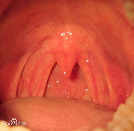 10个小方法缓解喉咙痛：常见病因及缓解疼痛小偏方