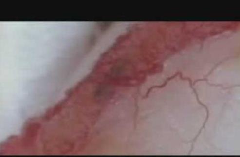 卵子图片是什么样的：排卵过程内窥镜特写图