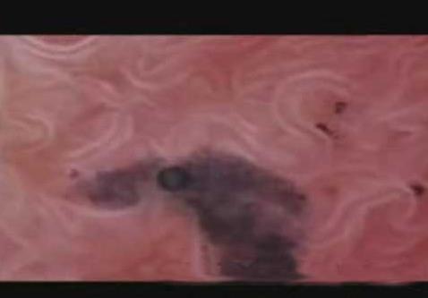 卵子图片是什么样的：排卵过程内窥镜特写图