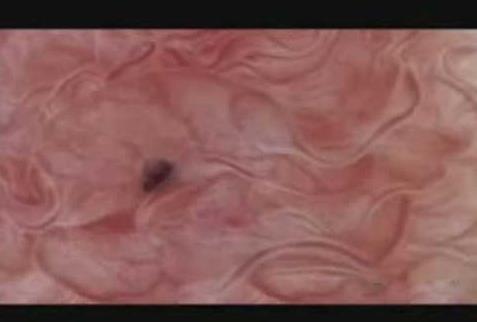 卵子图片是什么样的：排卵过程内窥镜特写图