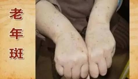 老年斑是怎么形成的:形成因素及如何预防(图) 老年斑是怎么形成的:形成因素及如何预防(图)