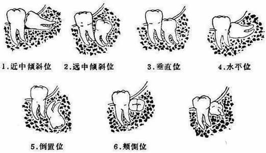 智齿一定要拔吗:这种情况智齿一定要拔掉(附拔智齿图)