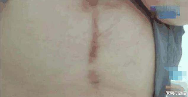 女子胸部太大的烦恼：结果去做缩胸手术