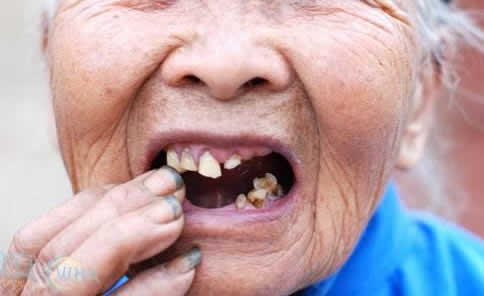 梦见自己牙齿掉了:梦见自己掉牙齿是什么意思 梦见自己牙齿掉了:梦见自己掉牙齿是什么意思