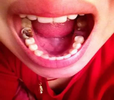 梦见自己牙齿掉了：梦见自己掉牙齿是什么意思