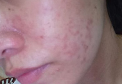 湿疹会传染吗：湿疹日常防护知识（图）