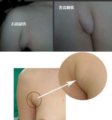副乳怎么办:坚持运动按摩效果好(图) 副乳怎么办:坚持运动按摩效果好(图)