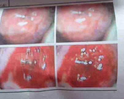 宫颈糜烂2度严重吗:有哪些危害一定要重视(图) 宫颈糜烂2度严重吗:有哪些危害一定要重视(图)