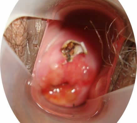 宫颈糜烂2度严重吗:有哪些危害一定要重视(图) 宫颈糜烂2度严重吗:有哪些危害一定要重视(图)
