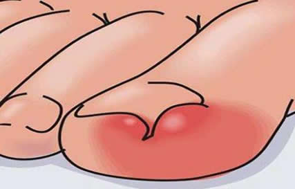 指甲长到肉里怎么办:想彻底搞定需要一些方法的 指甲长到肉里怎么办:想彻底搞定需要一些方法的