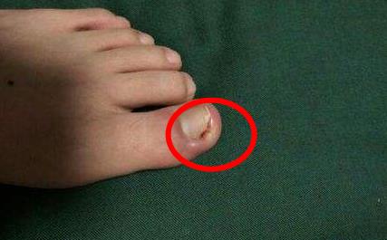 指甲长到肉里怎么办:想彻底搞定需要一些方法的 指甲长到肉里怎么办:想彻底搞定需要一些方法的