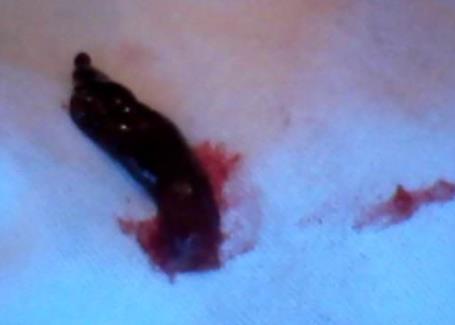 月经少而黑：原因及调理方法