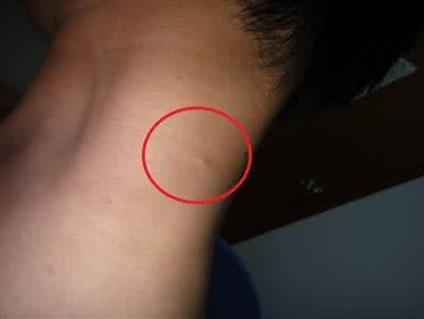 脖子上长小肉疙瘩：皮肤增生物或青春痘的一种（图）