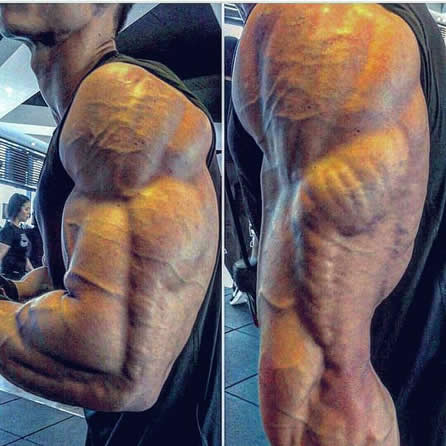 男子长出麒麟臂:或与不当拔罐有关(图) 男子长出麒麟臂:或与不当拔罐有关(图)