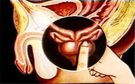 前列腺炎什么症状：了解前列腺炎教你如何预防