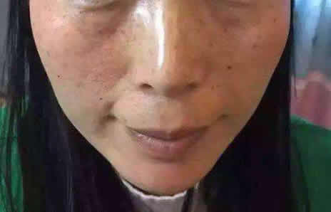 黄褐斑的简单去除方法:食教你疗及预防(图) 黄褐斑的简单去除方法:食教你疗及预防(图)