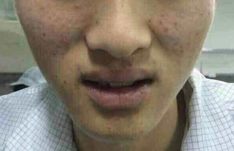 黄褐斑的简单去除方法:食教你疗及预防(图) 黄褐斑的简单去除方法:食教你疗及预防(图)