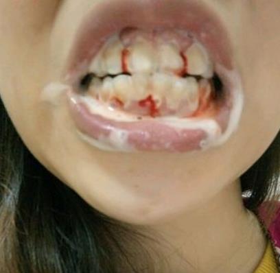 牙龈出血原因多为牙龈炎：教你如何科学的刷牙