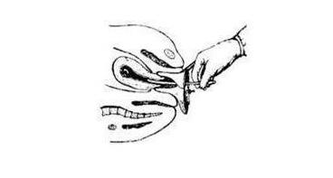 节育环怎么取（全过程图）