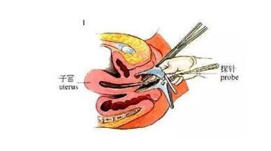 节育环怎么取（全过程图）