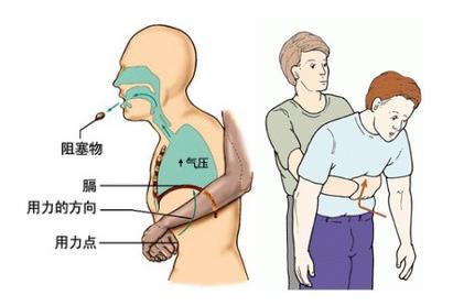 鱼刺卡到喉咙!救了100万人的方法!建议收藏 鱼刺卡到喉咙!救了100万人的方法!建议收藏