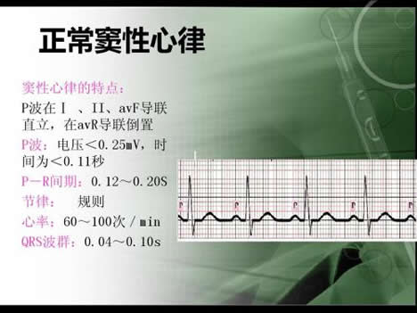 窦性心律是什么意思常见窦性心律介绍