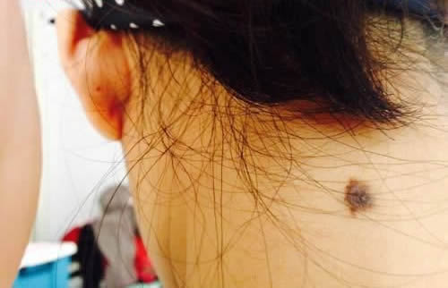 脖子上有痣代表什么：关于脖子上痣的传说和吉凶