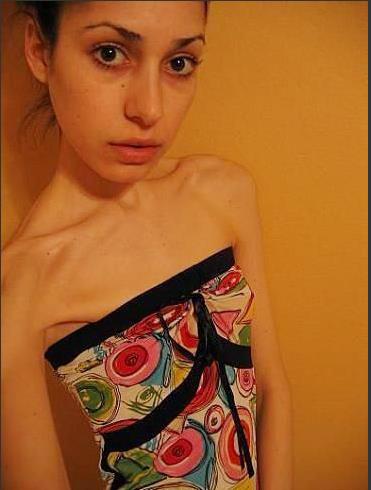 厌食症图片：厌食症患者骨瘦如柴（太可怕了）