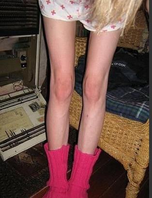 厌食症图片：厌食症患者骨瘦如柴（太可怕了）