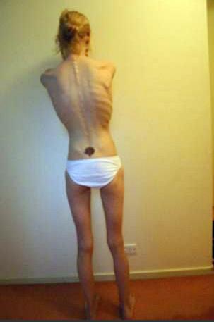 厌食症图片：厌食症患者骨瘦如柴（太可怕了）