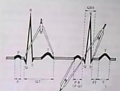 心电图怎么看:心电图诊断词语介绍和图示解读 心电图怎么看:心电图诊断词语介绍和图示解读