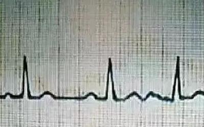 心电图怎么看:心电图诊断词语介绍和图示解读 心电图怎么看:心电图诊断词语介绍和图示解读