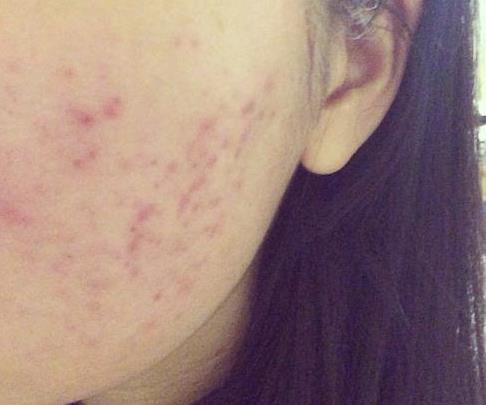 脸颊两侧长痘的原因：三个原因及护理祛痘（图）