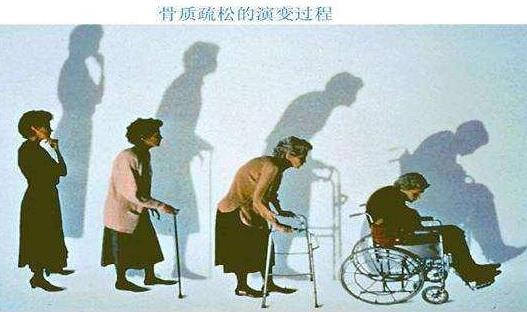 阿姨咳嗽脊柱骨折:骨质疏松是主因,揭其症状及预防 阿姨咳嗽脊柱骨折:骨质疏松是主因,揭其症状及预防