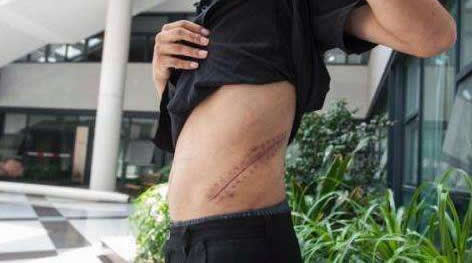 男子全身浮肿医生:你的肾咋没了（慢性肾衰竭尿毒症期）