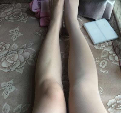 为什么女生膝盖经常会受伤：小姐姐这样回答（图）